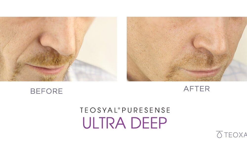Teosyal before and after - for cheek contouring and lift and nasolabial folds and smoker's lines before and after