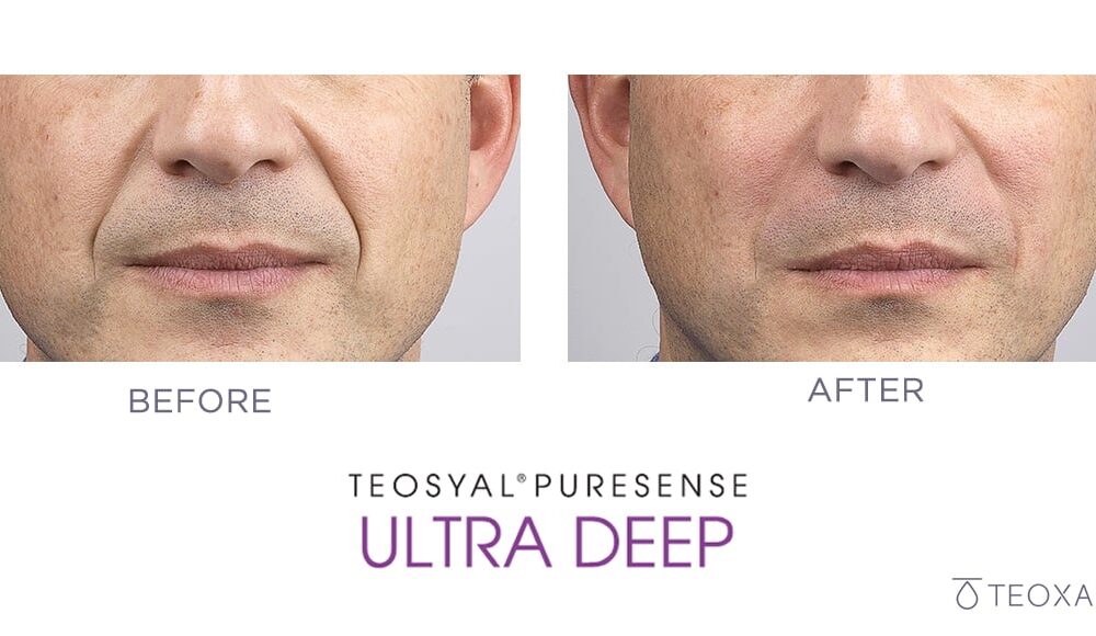 Dermal filler injection for lower face