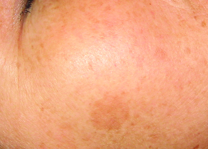A woman's back bite of a mosquito on the background