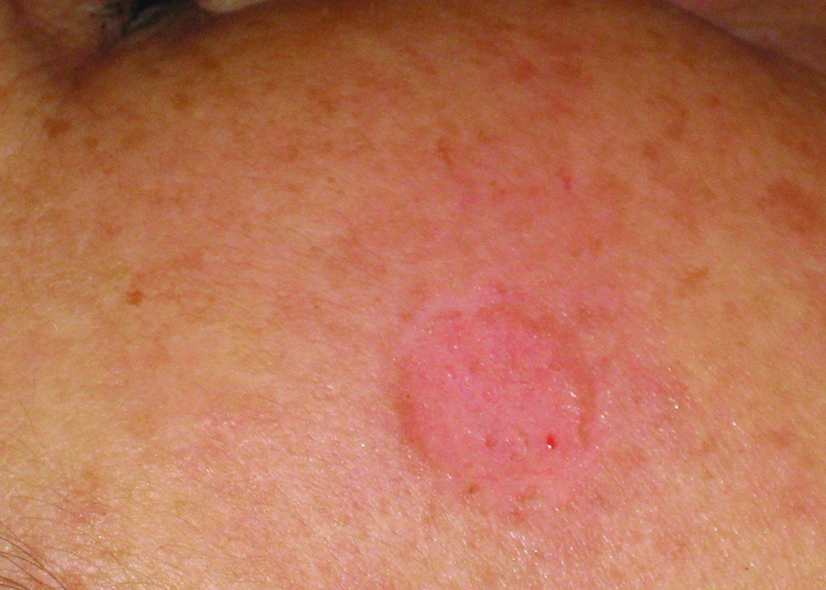 A man's back bite of a mosquito on the background