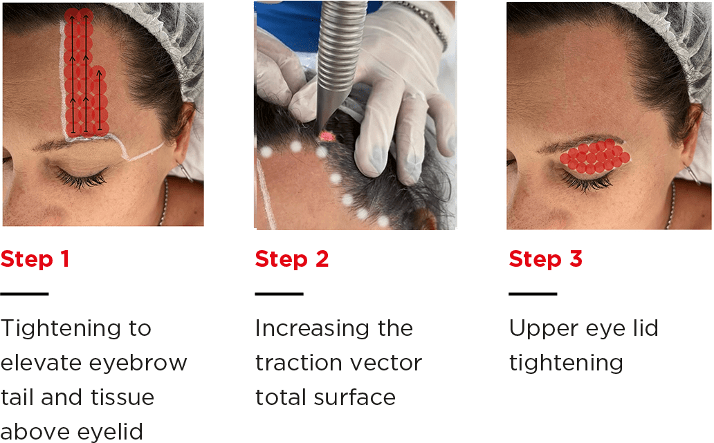 Vector Lift Steps image showing the concept of VectorLift® Non-Invasive Laser Eyebrow Lifting