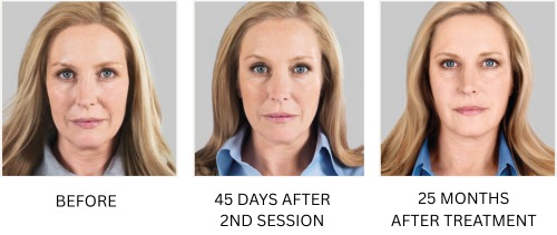 Sculptra before and after