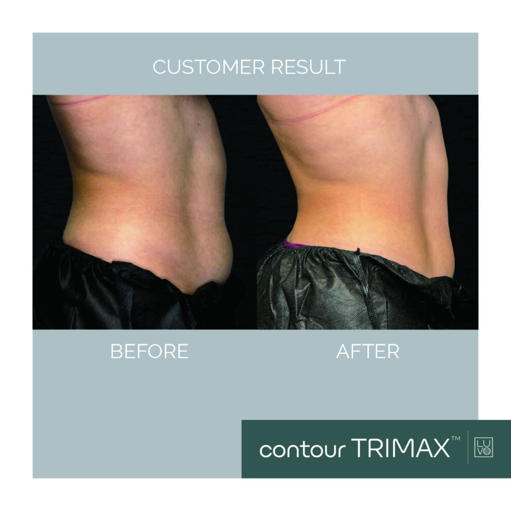contour TRIMAX before after 3