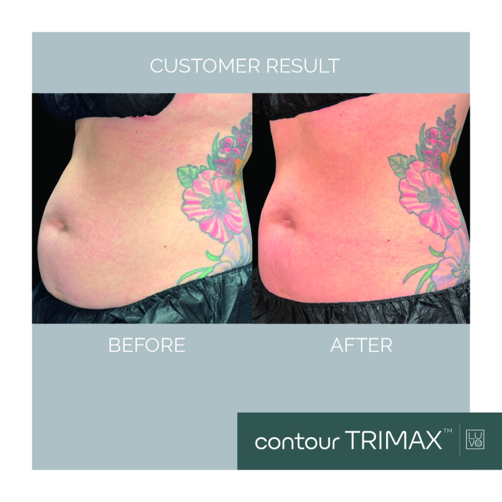 contour TRIMAX before after 5