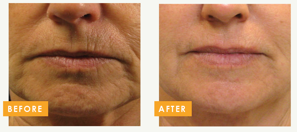 Tixel resurfacing treatment