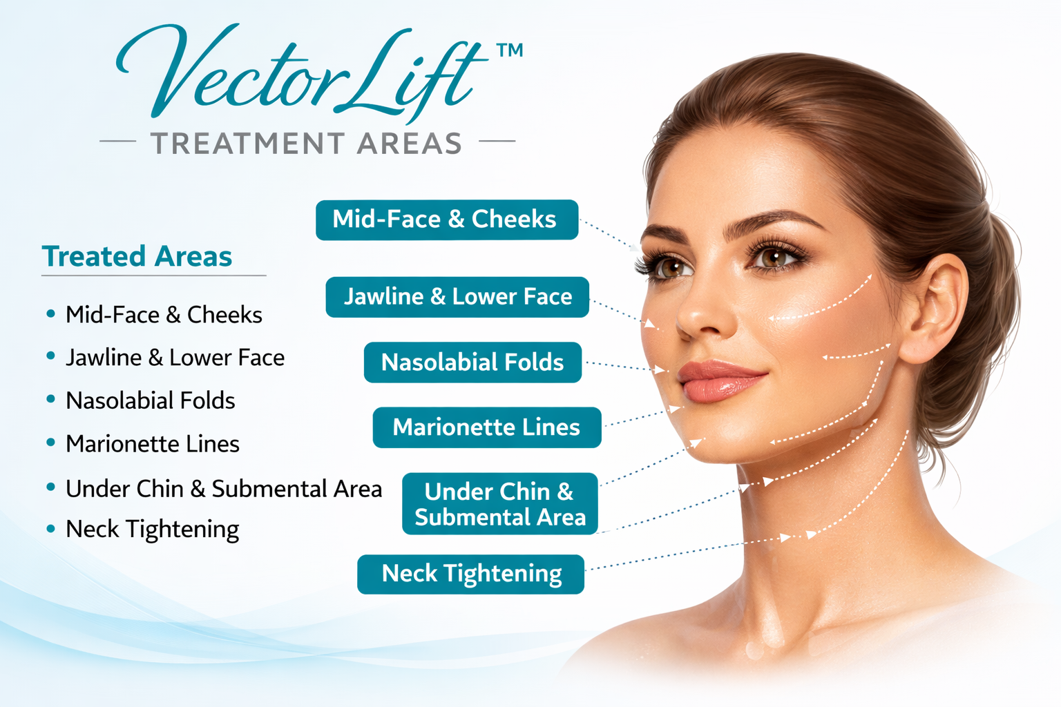 Fotona Vectorlift treatment area