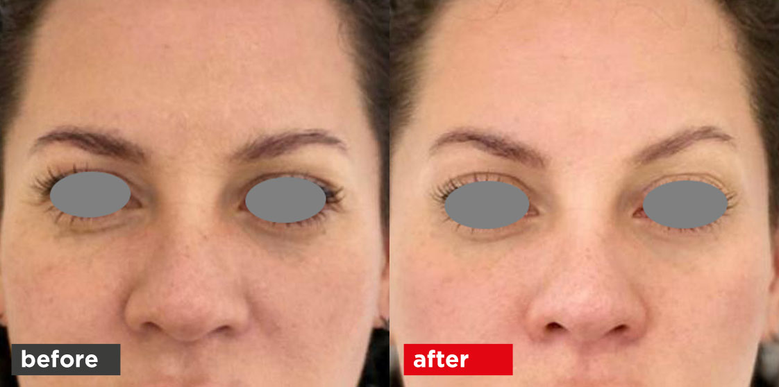 Fotona Vectorlift before after 01