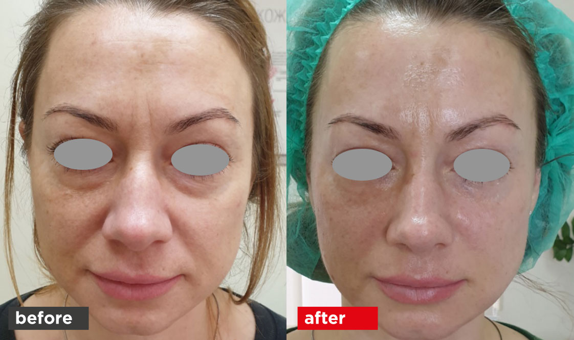 vectorlift before after 03