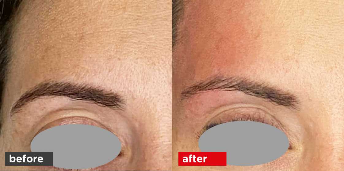 Fotona Vectorlift before after 02