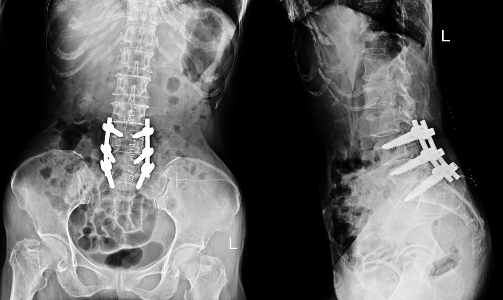 Xray of Lumbar Spine