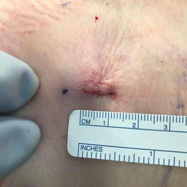 22 1 showing the concept of Less Than A 1cm Incision?