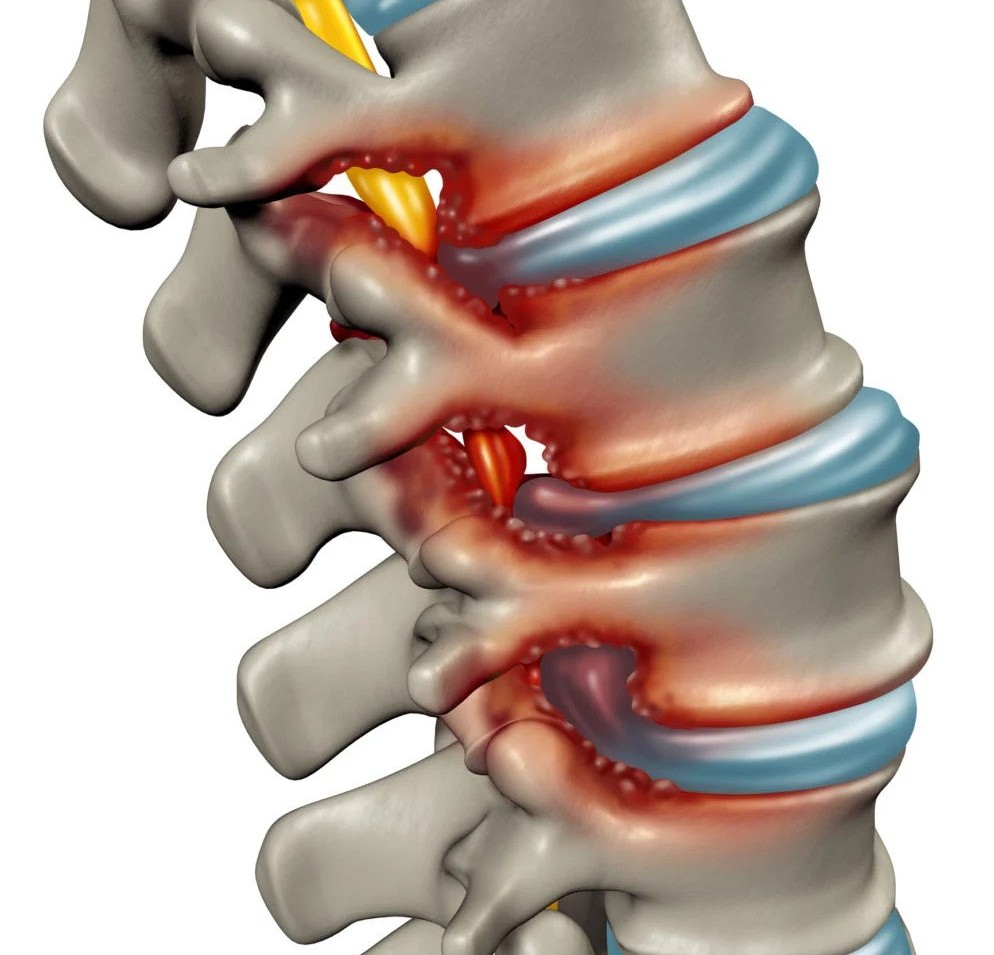 2es showing the concept of Spine Fusion Alternative?