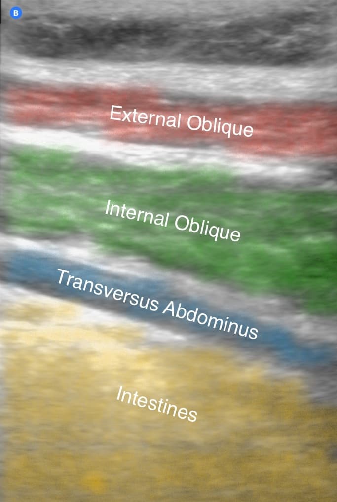 TAP Ultrasound showing the concept of Portable Ultrasound in the Pain Clinic