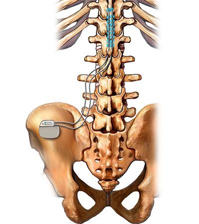 spinal cord stimulator showing the concept of New treatment for painful diabetic peripheral neuropathy