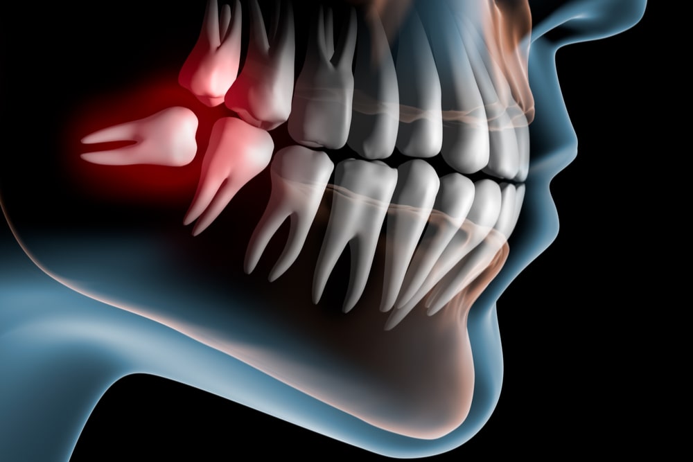 Pain caused by wisdom teeth