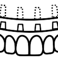 Full_arch_implant_wcos-removebg-preview