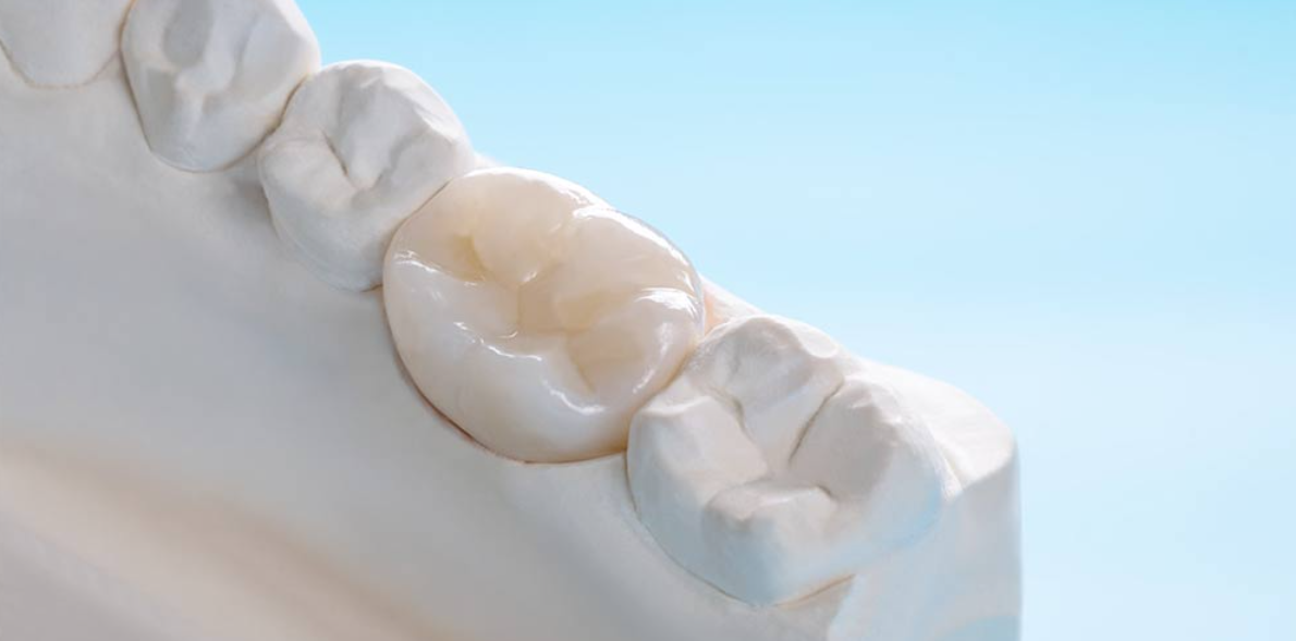 Closeup / Prosthodontics or Prosthetic / Single teeth crown and bridge equipment