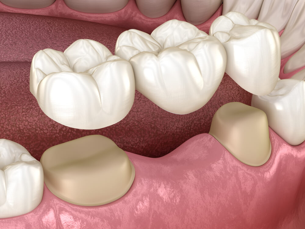 Dental bridge of teeth over molar and premolar