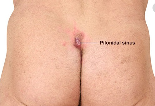 Pilonidal Cyst, Tailbone Cyst