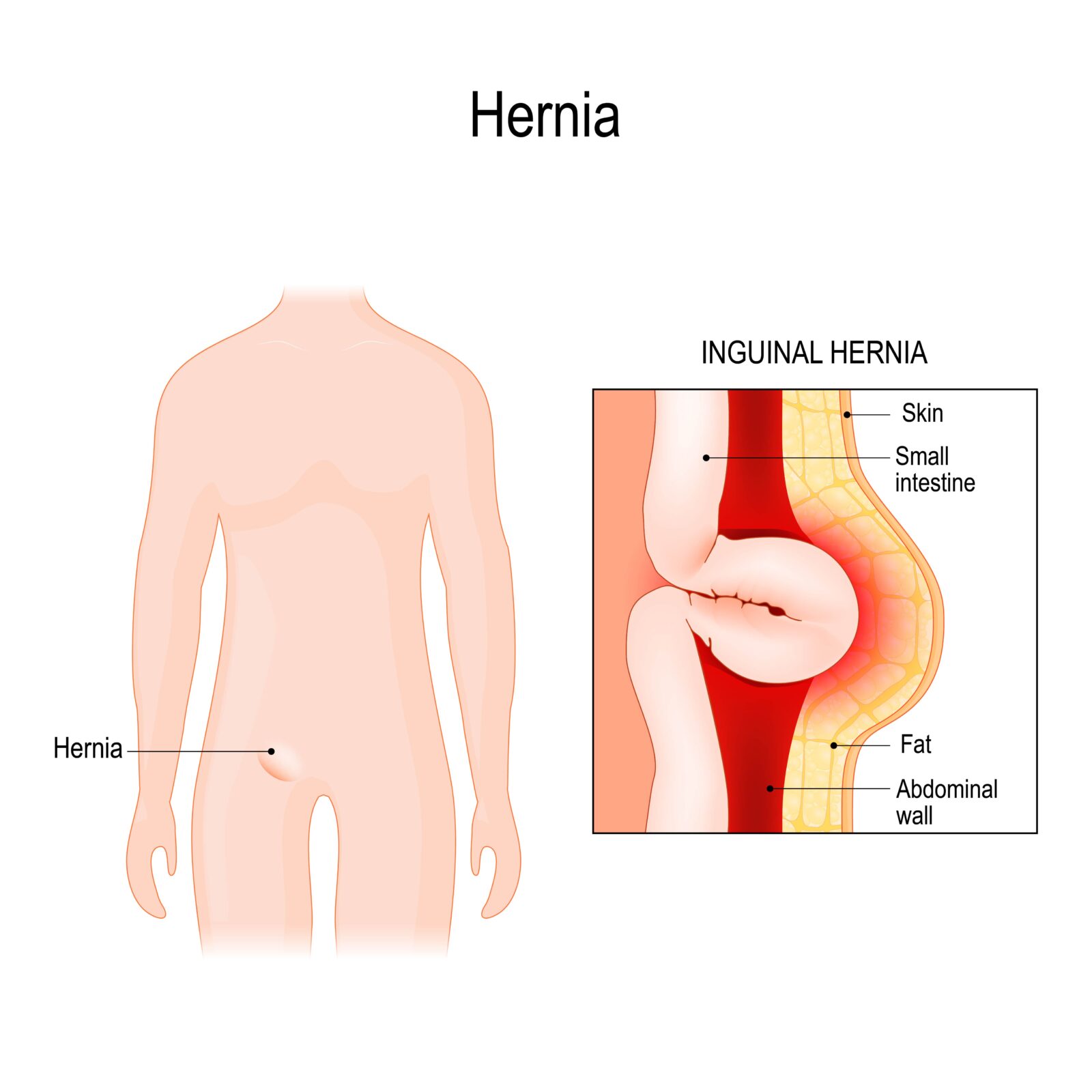 Inguinal (Groin) Hernia