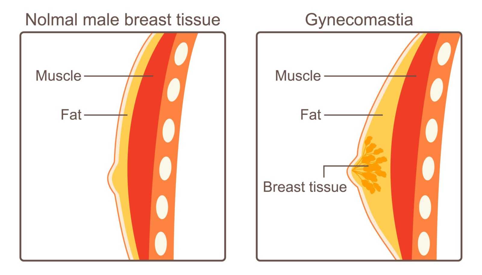 normal male breast tissue vs gynecomastia