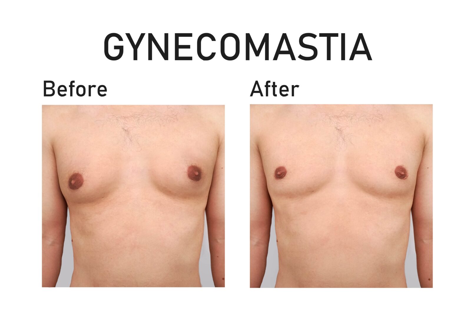 before and after gynecomastia treatment