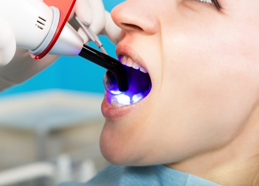 Dental Bonding showing the concept of Services