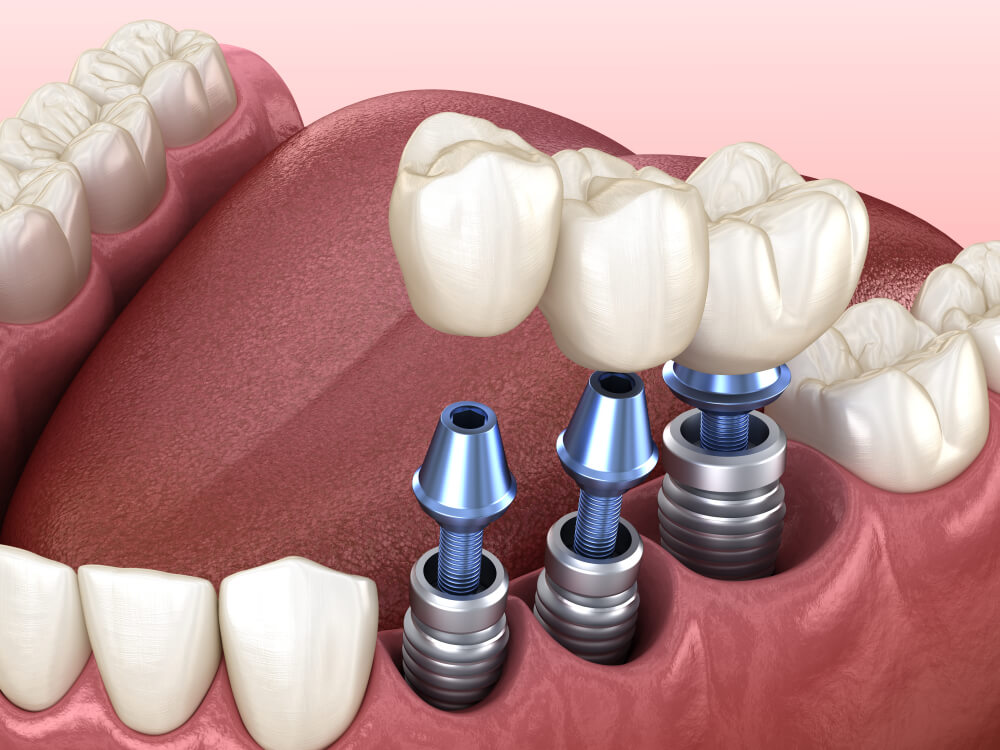 Dental Implants showing the concept of Services