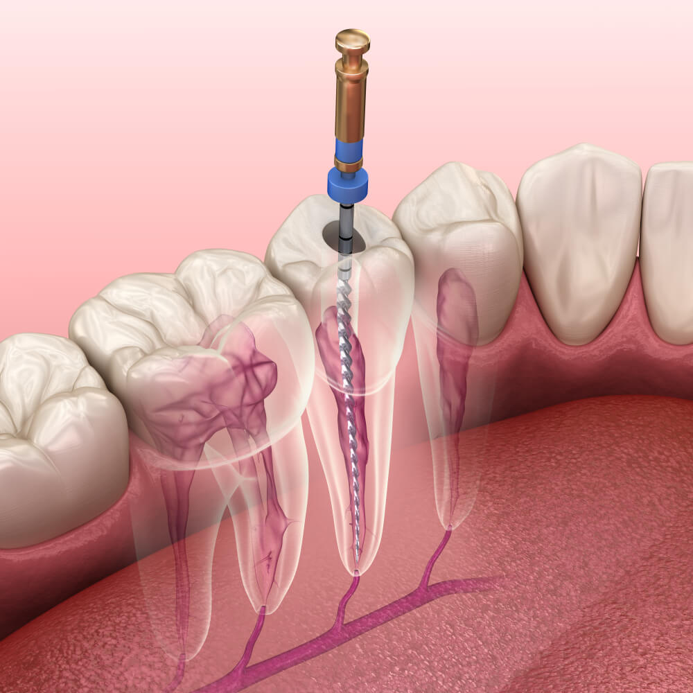 Root Canals showing the concept of Services