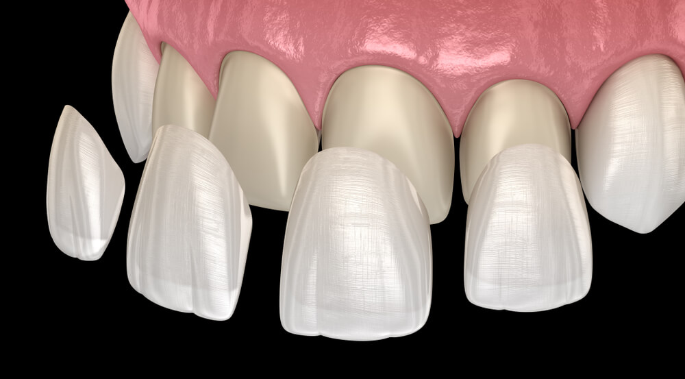 Veneers and Laminates showing the concept of Services