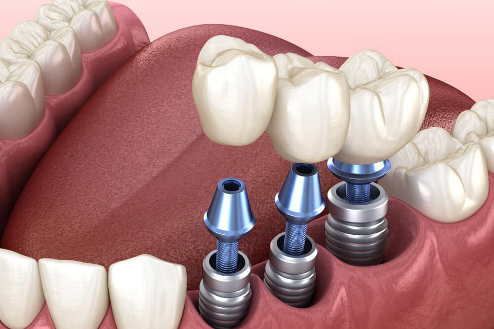 3 tooth crowns placement over 3 implants