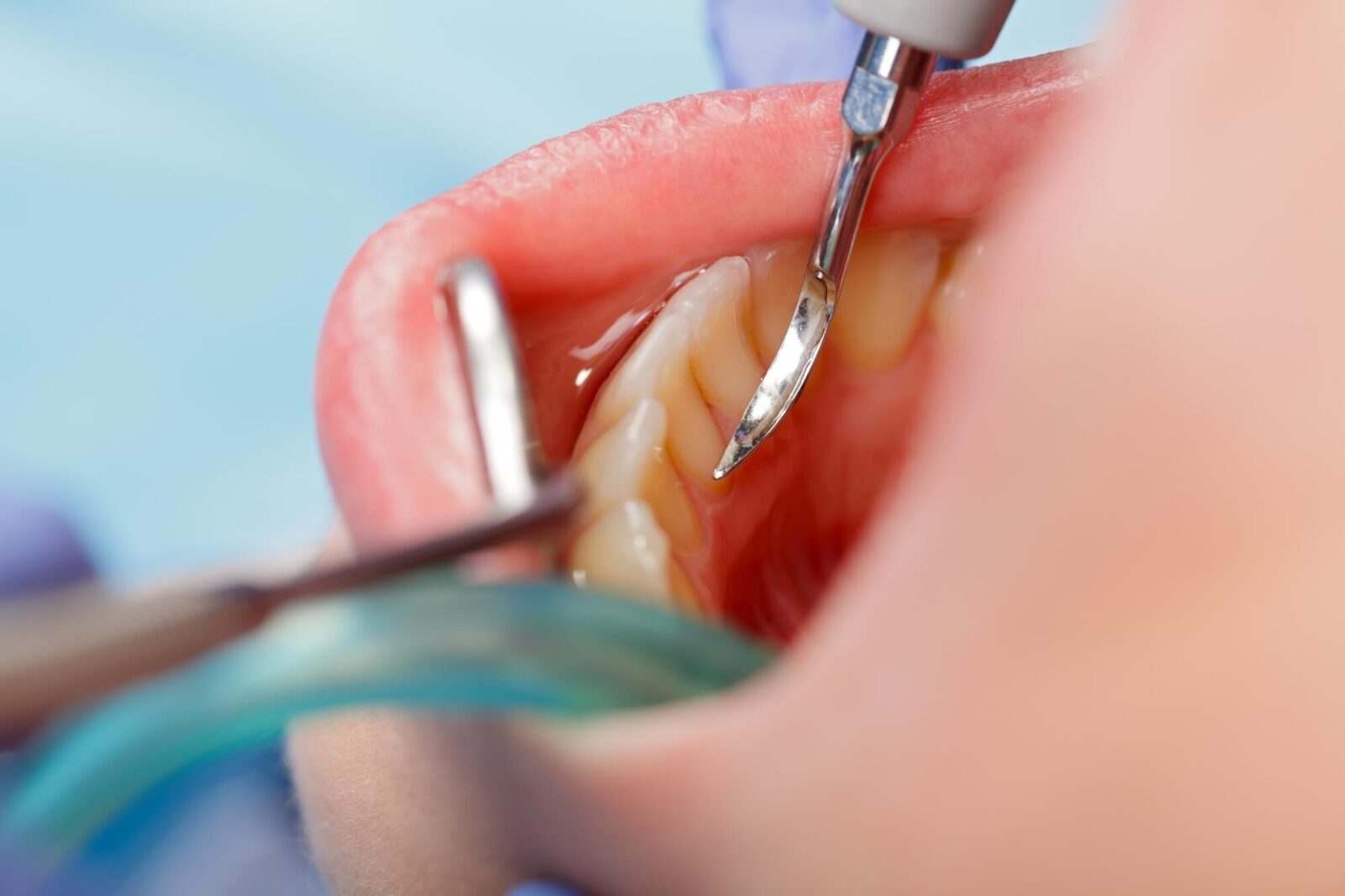 dentist performs same day dental coral springs