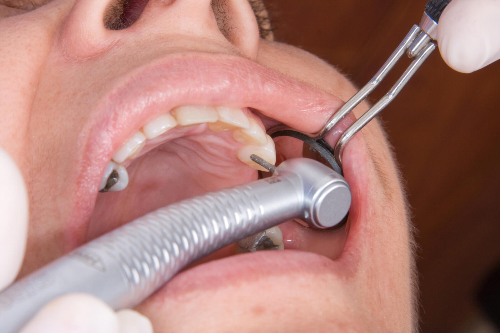 patient getting Coral Springs dental fillings