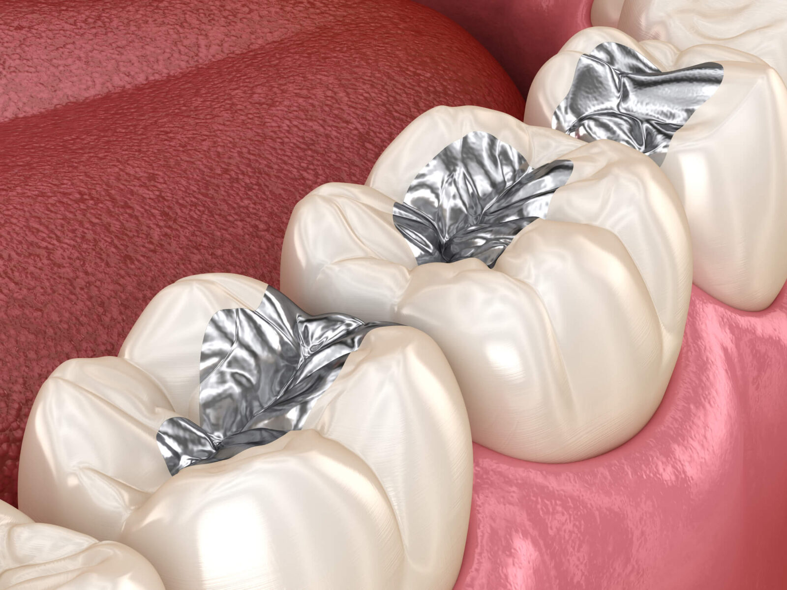 Coral Springs dental fillings silver-colored