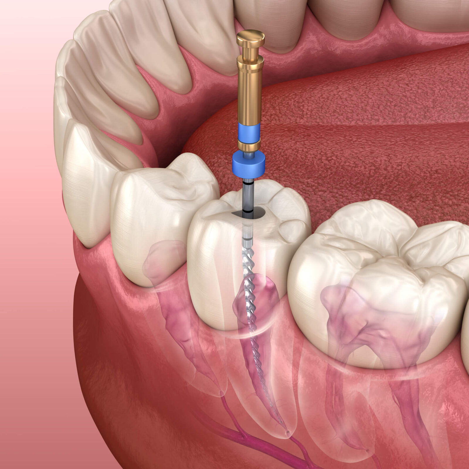 coral springs root canal procedure