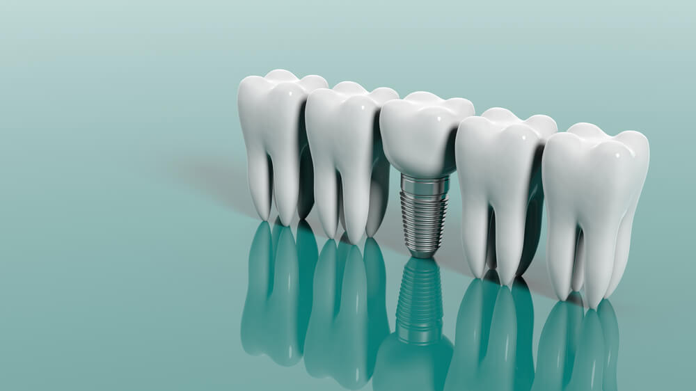 Teeth and dental implant. 3d illustration