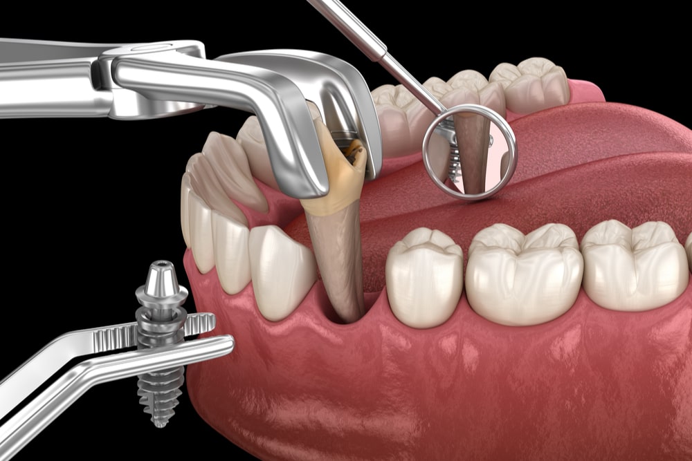 Medically accurate 3D illustration of dental treatment