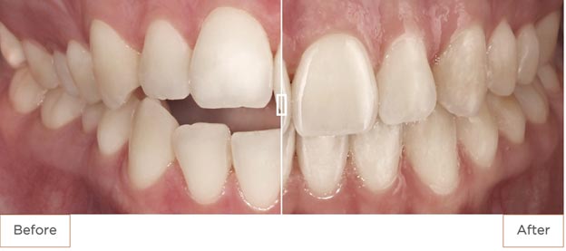 before after showing the concept of Clear Aligners