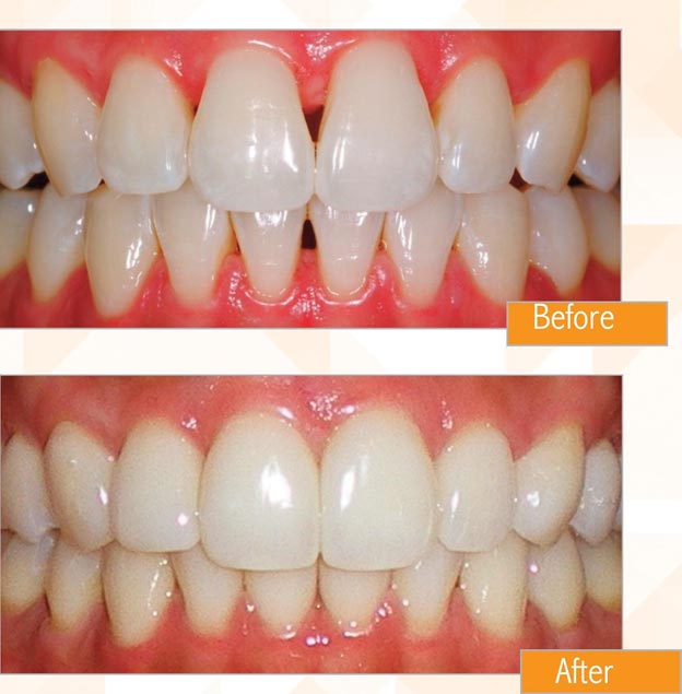 teeth showing the concept of The BIOCLEAR method