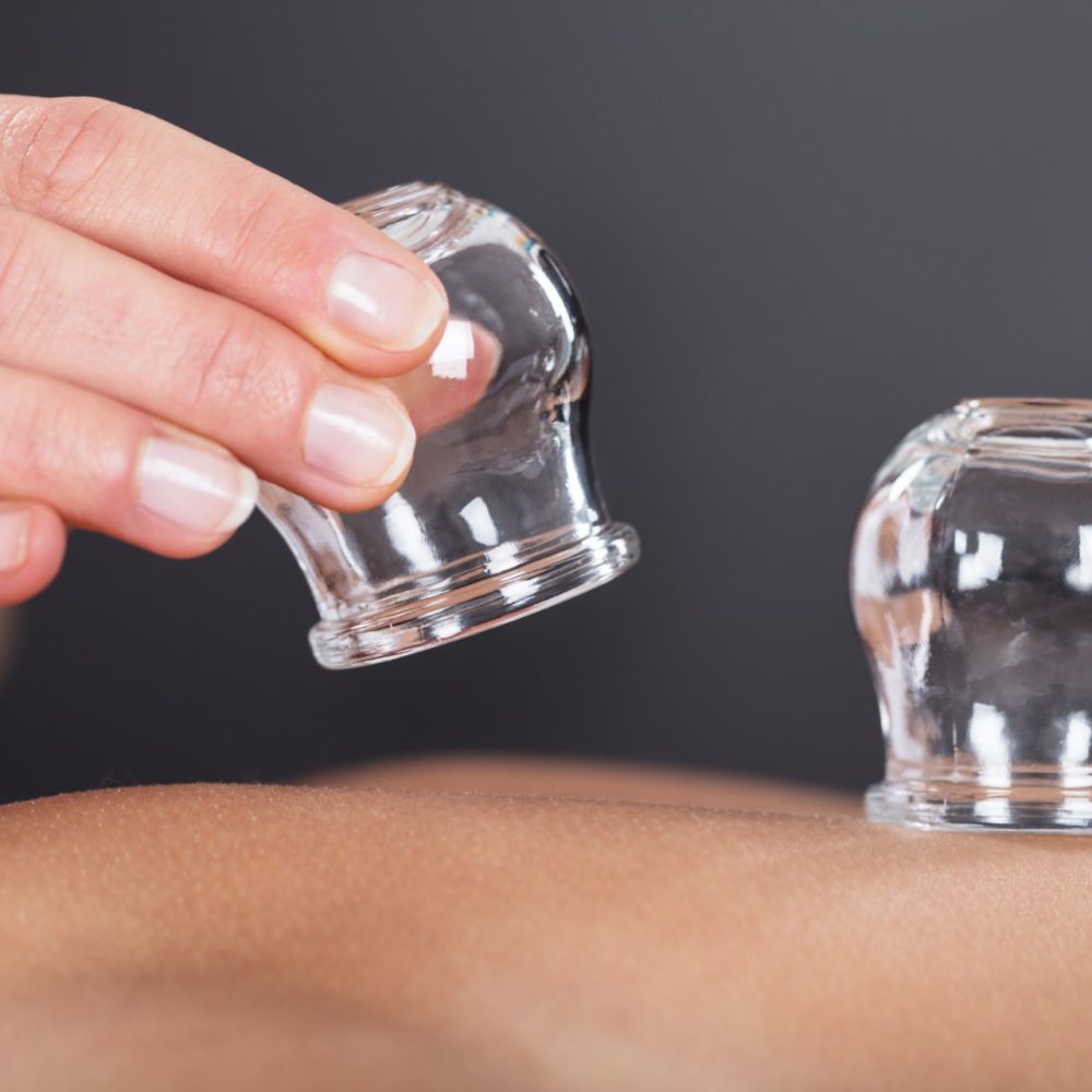 A Therapist Giving Cupping Treatment On Back
