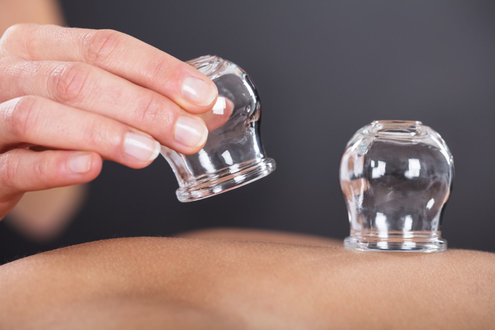 A Therapist Giving Cupping Treatment On Back