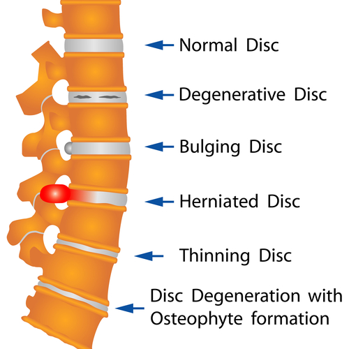 Spine conditions