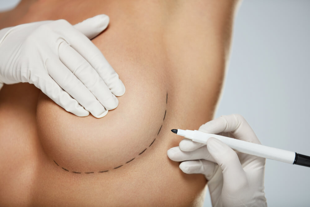Doctor Drawing LinesBefore Breast Augmentation Operation