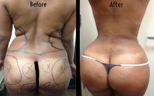 Liposuction and BBL Before and after