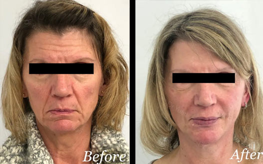 Face Lift before and after
