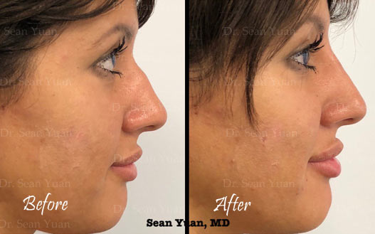 Nasal hump reduction Before and after