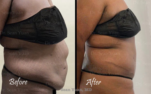 Before and after Tummy Tuck surgery