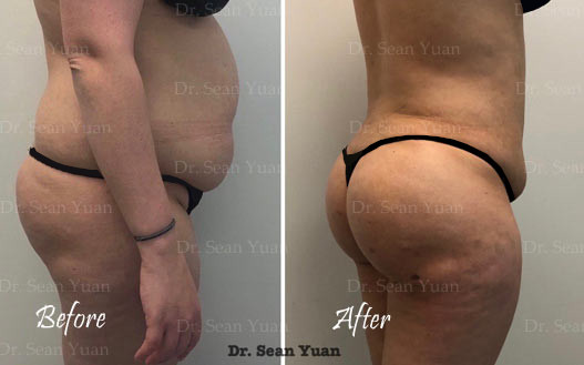 Abdominal and Back Liposuction Before and after