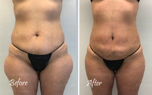 Leg Liposuction Before and after