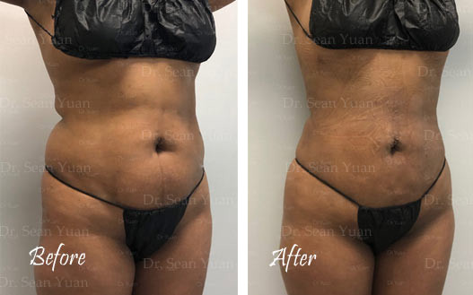 Abdominal Lipsuction Before and after